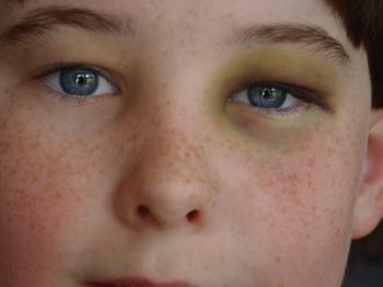 black eye, black eye question and answers | Firmoo Answers