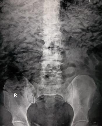 Surgical emphysema: crumpled paper appearance | Radiology Case ...