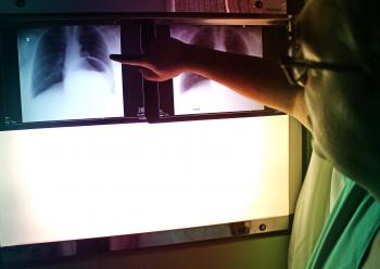 Doctor Pointing to X-Ray Picture - Chest PA Radiography