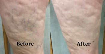 Spider Vein Treatment | Green Bay Vein Center