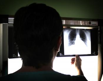 Medical doctor examining a chest PA x-ray image