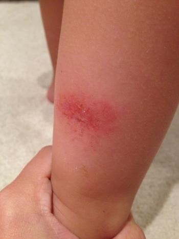 An Effective Natural Remedy for Severe Mosquito Bites | Bug bite ...