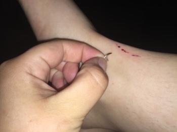 Cat scratched me so hard his nail became embedded in my leg. - Album ...