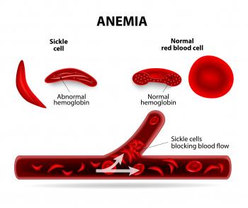 One-Time, Lasting Treatment for Sickle Cell Disease May be on ...