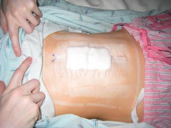 Living with Gastroparesis » Uncategorized