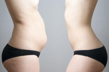 I Am Skinny But Have Excess Stomach Weight | LIVESTRONG.COM