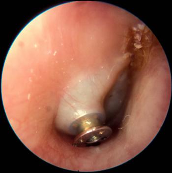Otitis Media Guide :: Myringotomy and Ventilation Tubes :: 6_10