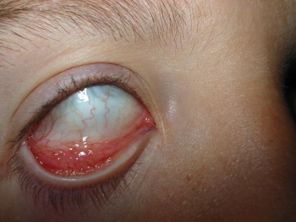 Eye