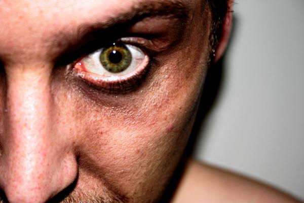 Eye