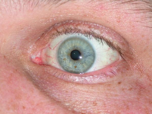 Eye