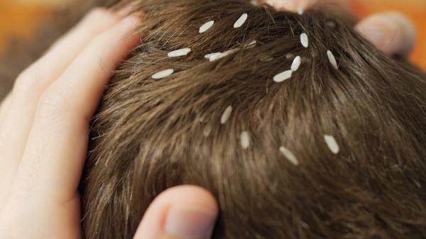 Lice