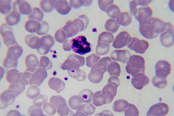 Malaria