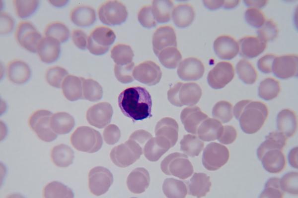 Malaria